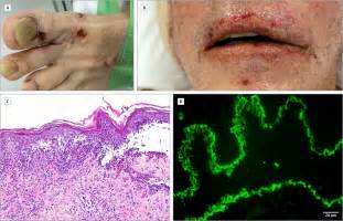 Polymorphic Blistering Eruption And Stomatitis In A Patient With Non