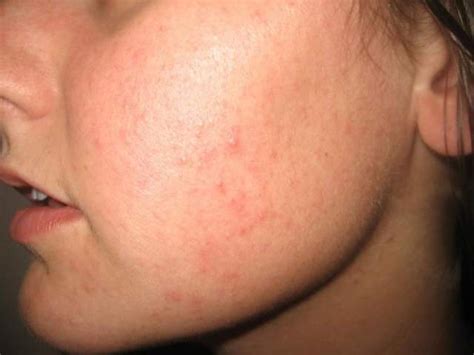 Red Bumps On My Face Dorothee Padraig South West Skin Health Care