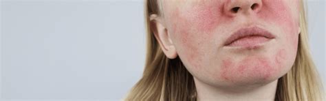Red Blotches On The Face Causes And Treatments Lumenis
