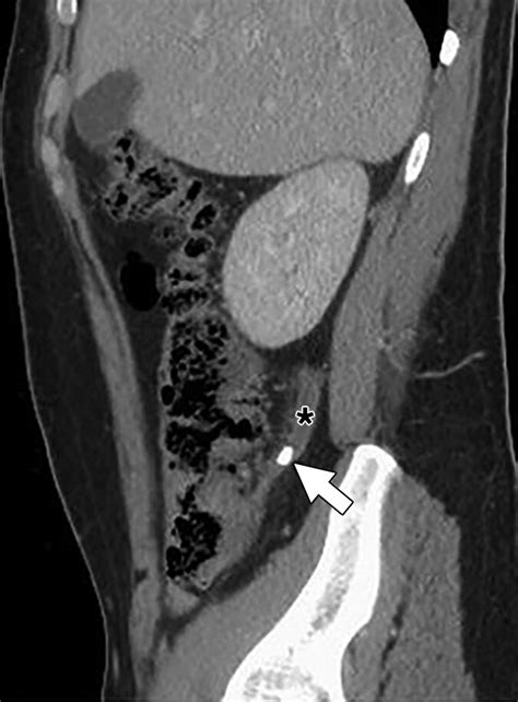 Prevalence Of Appendicoliths Detected At Ct In Adults With Suspected