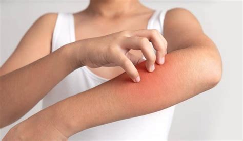Menopause Eczema Causes Treatments Prevention Home Remedies