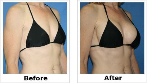 Breast Augmentation Before After Gal15 Set10 Cosmetic Surgery Pinterest Surgery