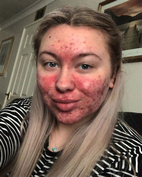 Student Who Spends Two Hours A Day Hiding Her Severe Acne With Make Up