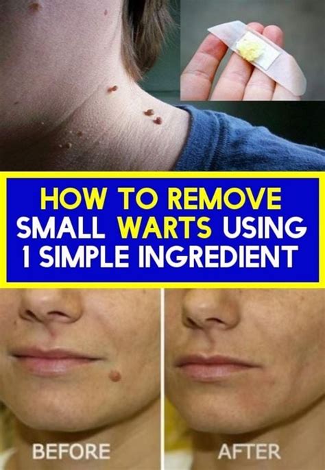 How To Remove Small Warts By Using A Single Ingredient Rharveycliniccare