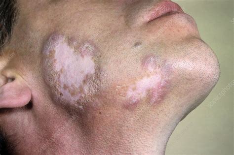 Lupus Erythematosus On The Face Stock Image C0131023 Science