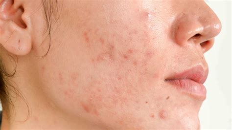 4 Things Your Acne Is Really Trying To Tell You Endorphitness