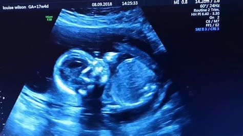 17 Weeks Pregnant Ultrasound Gender Scan Baby Moving Youtube