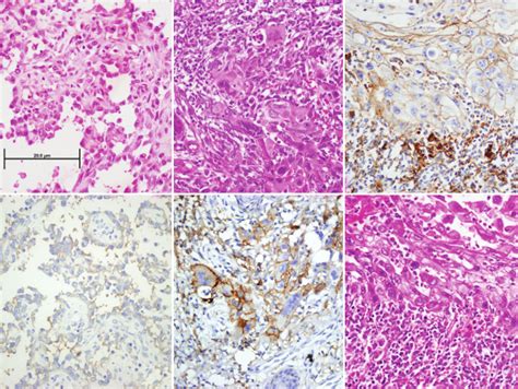 Pd L1 For Cutaneous Squamous Cell Carcinoma A B C Cscc