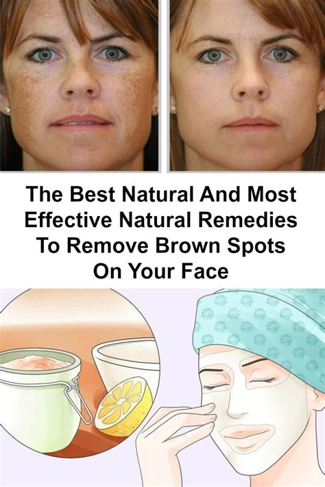 The Brown Spots On The Face Are Very Common Issue And Both Men And
