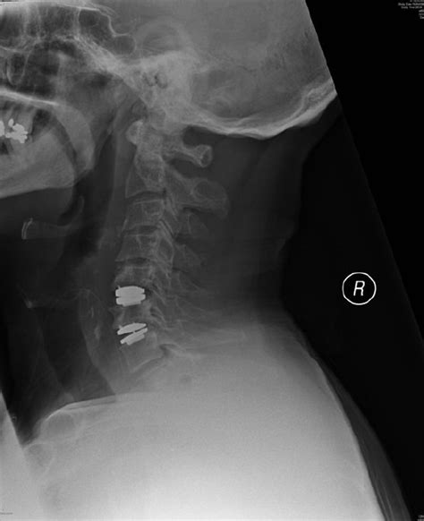 Postoperative Lateral X Ray Of 2 Level Cervical Disc Replacement