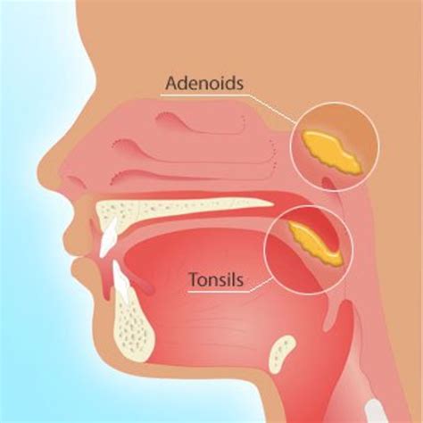 Does My Child Need Their Tonsils And Adenoids Removed Wehavekids