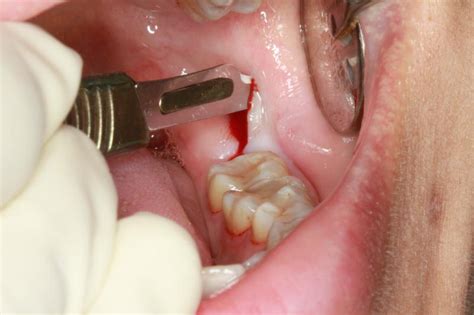 Impacted Tooth A Definitive Guide Dentist Says