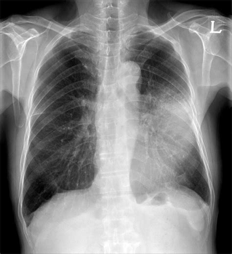 Chest X Ray Showed The Ill Defined Patchy Mass Opacity With Surrounding