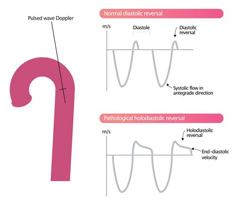 Aortenklappeninsuffizienz Ekg And Echo