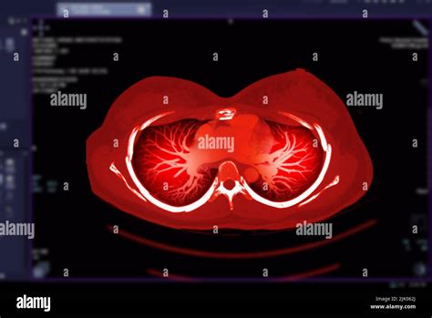 Ct Chest Or Ct Scan Of Lung Axial And Coronal View Stock Photo Alamy
