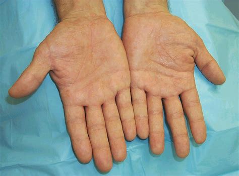 Skin Disease Types Vesicular Hand Dermatitis Skin Disease Type