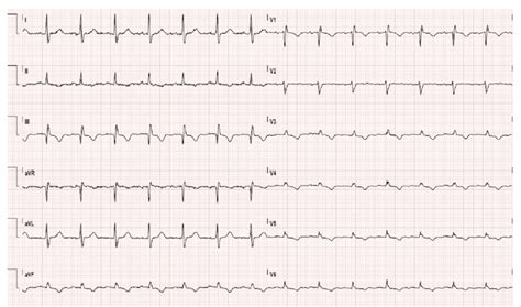 ECG Demonstrates Right Axis Deviation And Right Bundle Branch Block