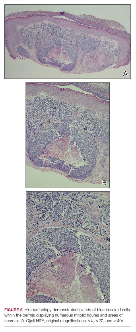 Merkel Cell Carcinoma In A Patient With A History Of Psoriasis Mdedge