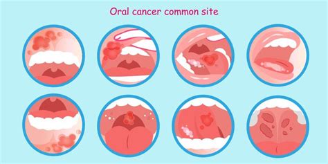 Everything You Need To Know About Oral Cancer Heritage Park Dental