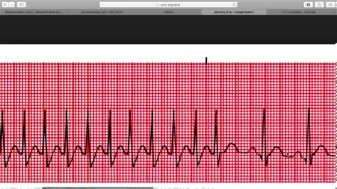 Paroxysmal Supraventricular Tachycardia ECG