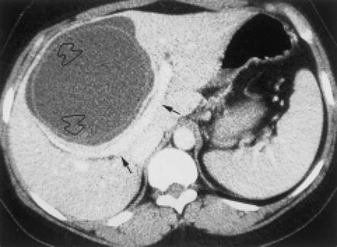 Ct Scan Shows The Large Hydatid Cyst With A Floating Membrane Open