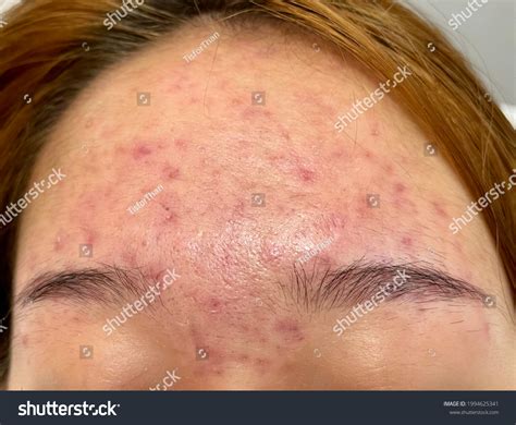 Multiple Illdefine Erythematous Rash Forehead Lady ภาพสต็อก 1994625341
