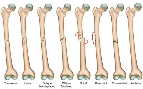 Distal Femoral Fractures A Comparison Between Single Lateral Plate