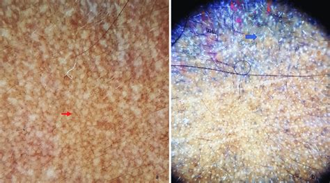 A Dermoscopy Of Early Pigmented Contact Dermatitis Shows Diffuse