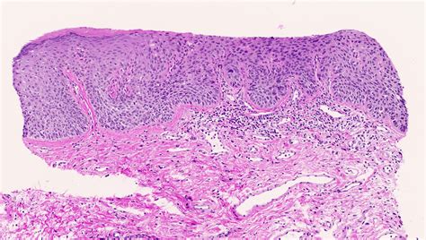 Pathology Outlines Hpv Associated Squamous Intraepithelial Lesion Sil