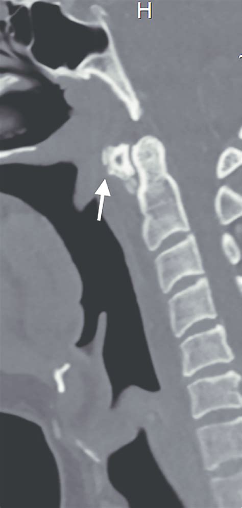 Ct Scan Of The Neck With Anterior Soft Tissue Calcification White