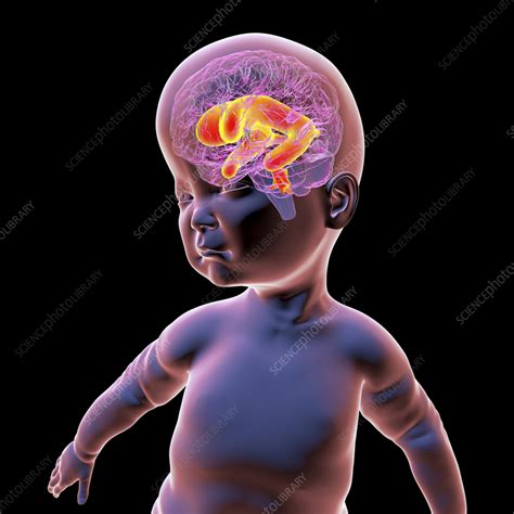 Baby With Enlarged Lateral Ventricles Illustration Stock Image