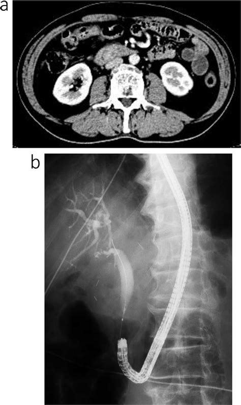 Contrast Enhanced Computed Tomography Ct And Endoscopic Retrograde