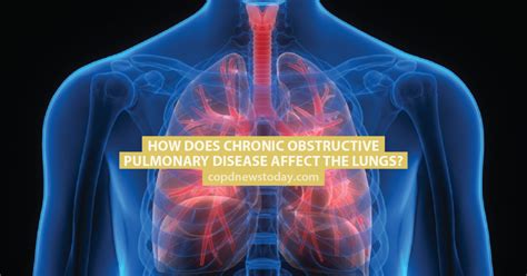 How Does Copd Affect Respiratory System Pelajaran