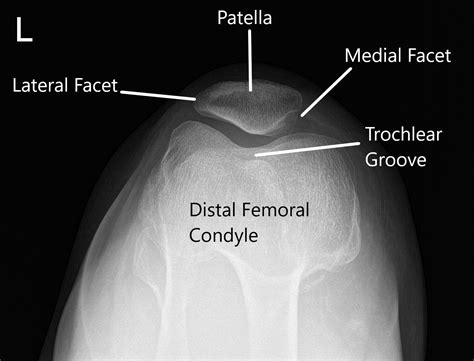 Case Study Patellofemoral Chondroplasty In 60 Yr Old Female