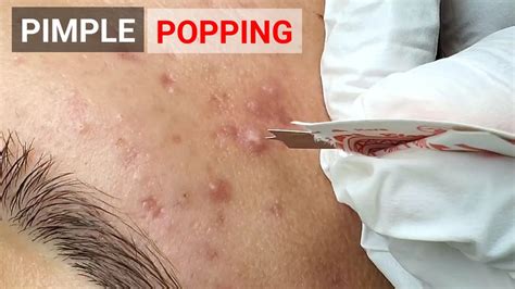 PIMPLE POPPING VIDEO YouTube