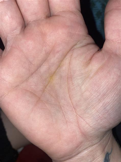 Yellow Color In Palm Of Right Hand What Is It R Diagnoseme