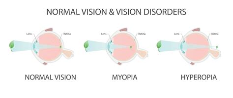Myopia Vs Hyperopia Whats The Difference Kelowna