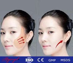 Pdo Thread For Face Or Body Lifting