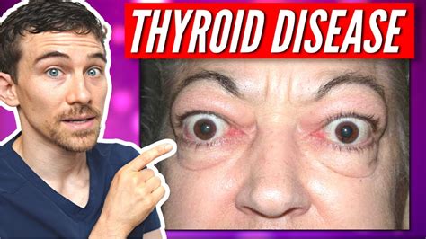 7 Signs Of Thyroid Eye Disease And Graves Disease Youtube