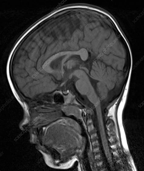 Brain Of A 5 Year Old Normal Mri Stock Image C0393502 Science