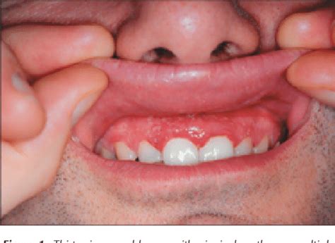 Figure From Acute Herpetic Gingivostomatitis In Adults A Review Of Cases Including