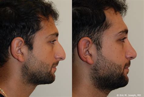 Eric M Joseph Md Rhinoplasty Before And After 3 Months After Male