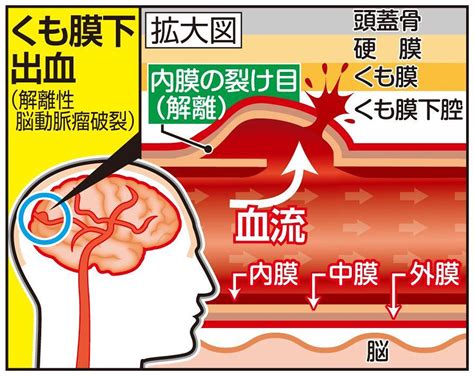 本站内容可能令人反感；不将本站内容派发，出售。 出租，交给或出借予年龄未满18岁人士出示，播放或播映。 this article contains material which may offernd and may not be distributed,circulated,sold,hired,given,lent,shown, played or projected to a. くも膜下出血のジャニー社長、今後も慎重な経過観察が必要 ...