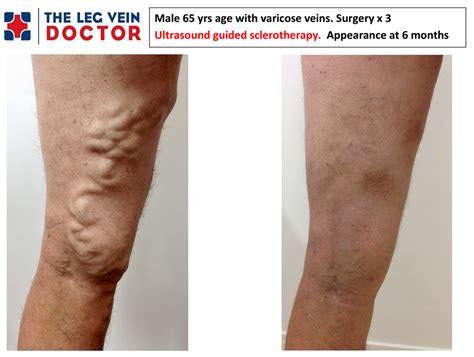 Why Do Varicose Veins Come Back Following Surgery — The Leg Vein