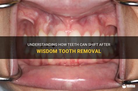 Understanding How Teeth Can Shift After Wisdom Tooth Removal Medshun