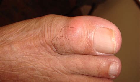 An Unusual Case Of A Painful Big Toe The Bmj