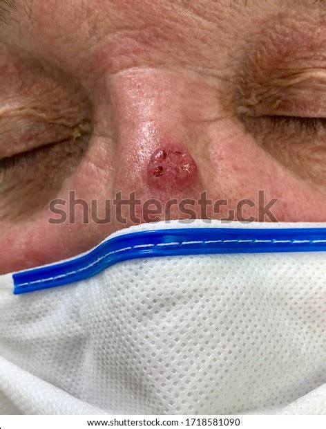 Single Ulcer Nose Elderly Man Stock Photo 1718581090 Shutterstock