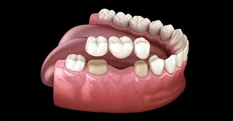 Crowns And Bridges Royal Replacement Of Your Missing Teeth Oris