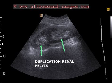 Ultrasound Imaging Duplication Collecting System Kidney
