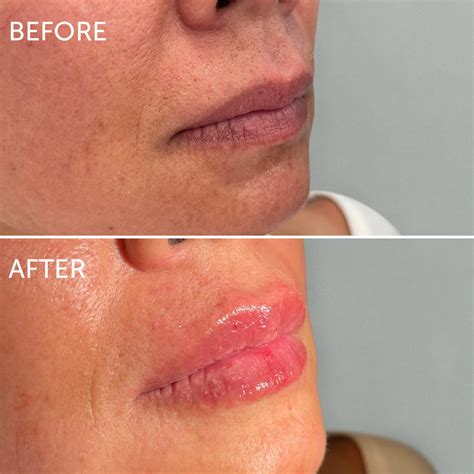 Lip Filler Swelling Stages A Week By Week Guide